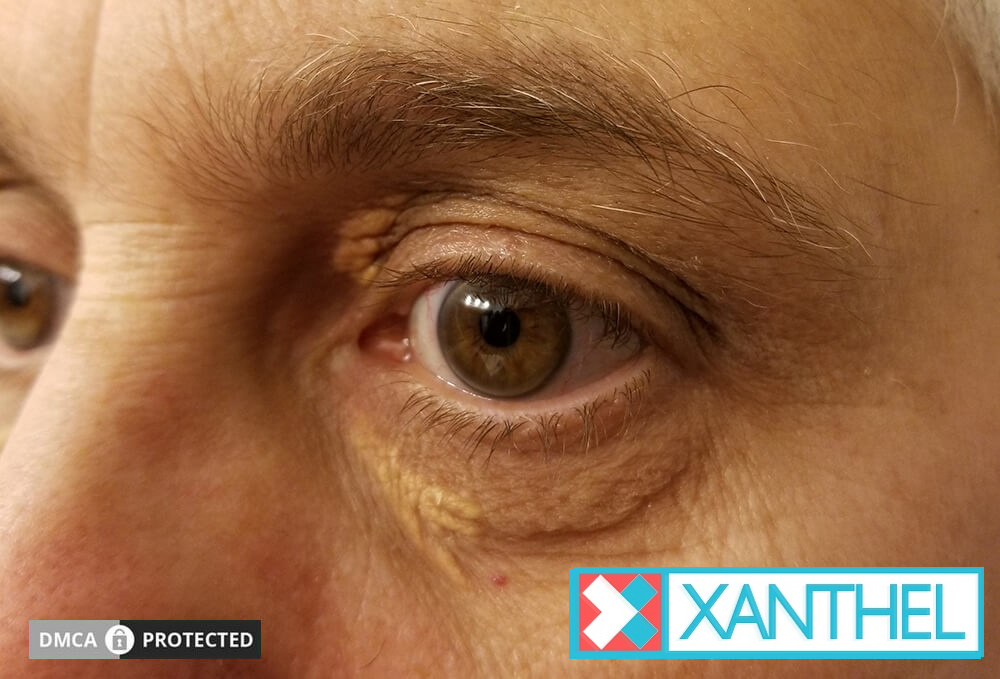 What is xanthelasma: creamy yellow patches on the lids