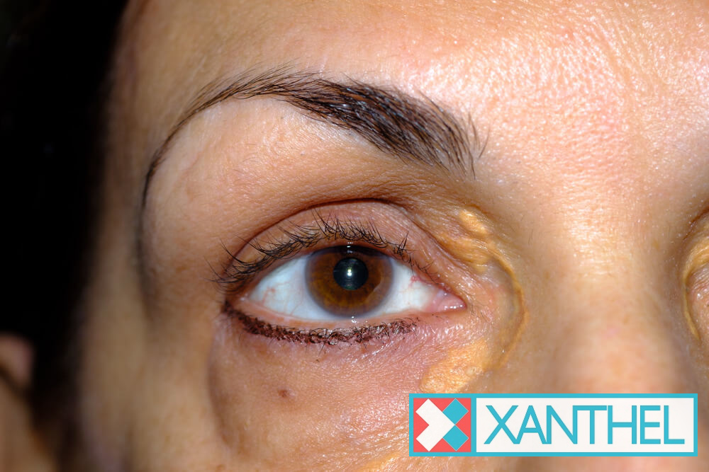 Xanthelasma patches around the eyes