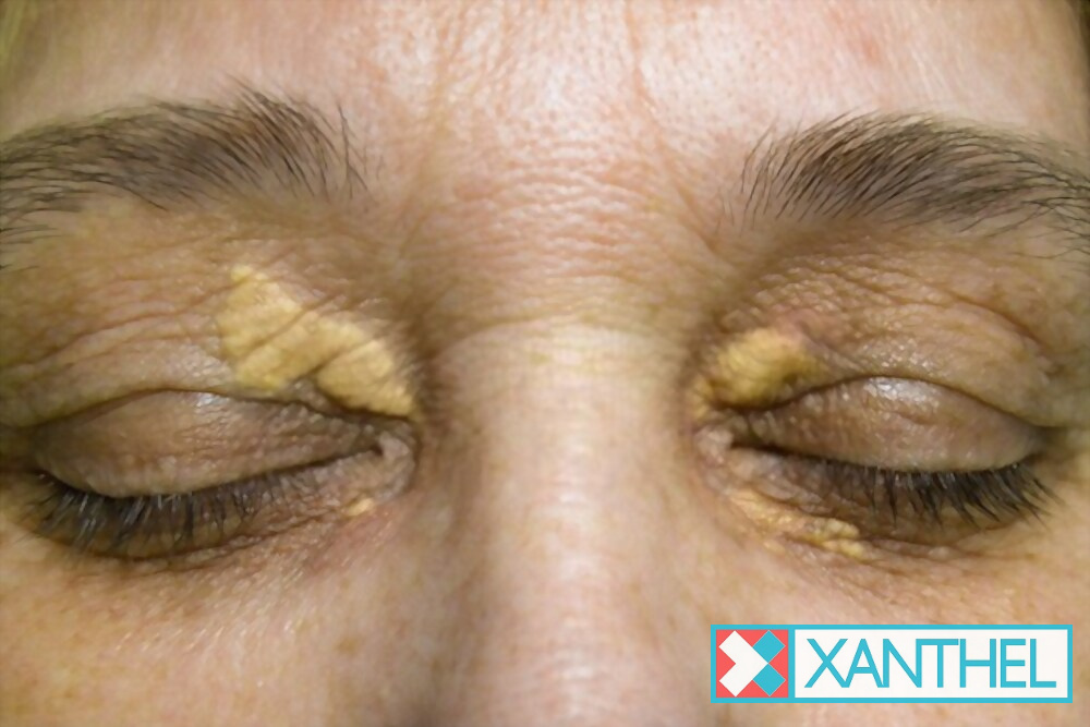Xanthelasma removal: yellow patches on both eyelids