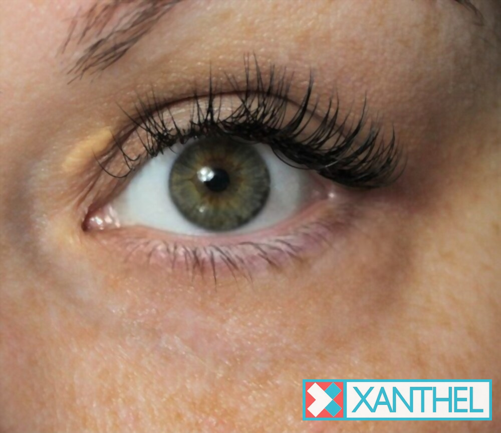 TCA for xanthelasma: a cholesterol deposit near the eye