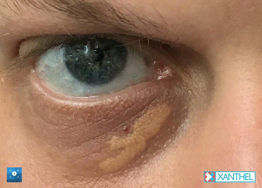 Xanthelasma home removal: patches near the eyes