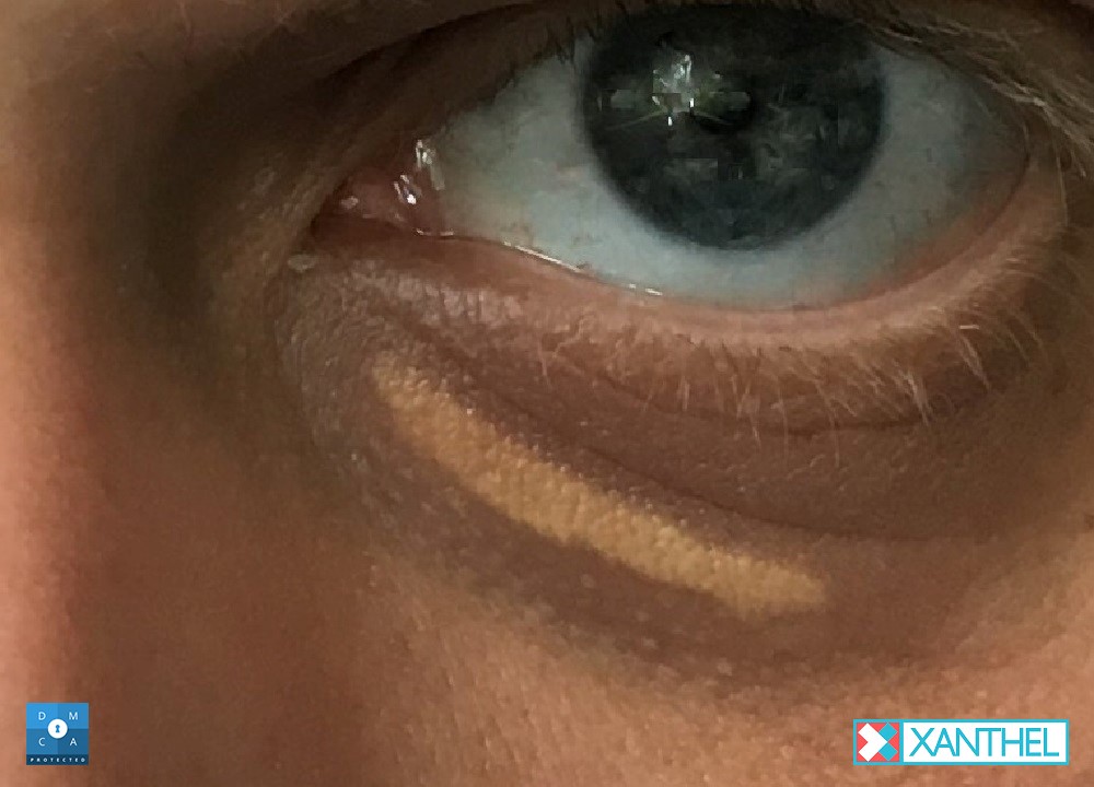 Xanthelasma under the eye before treatment