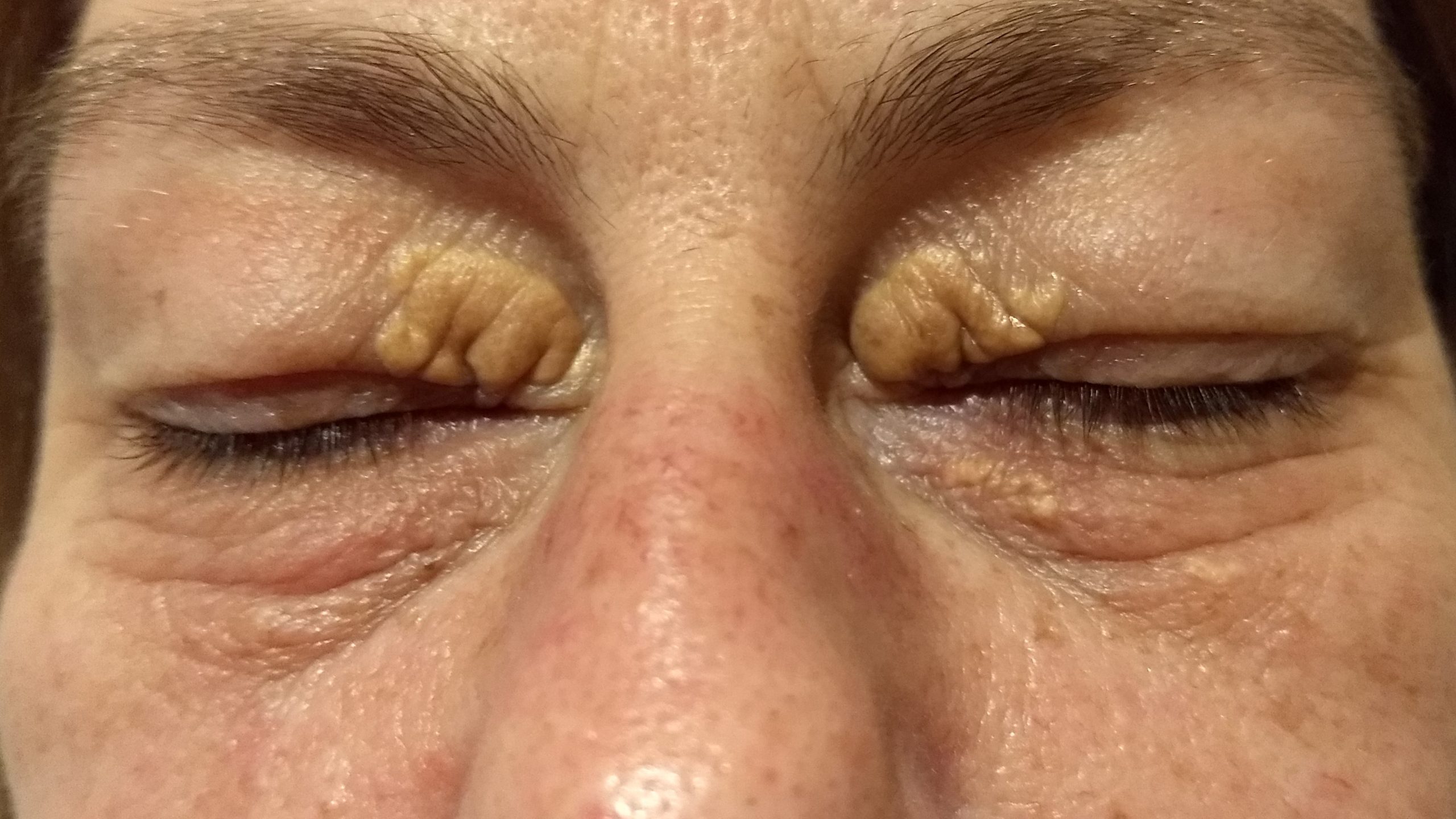 are there any natural ways to remove xantelasma