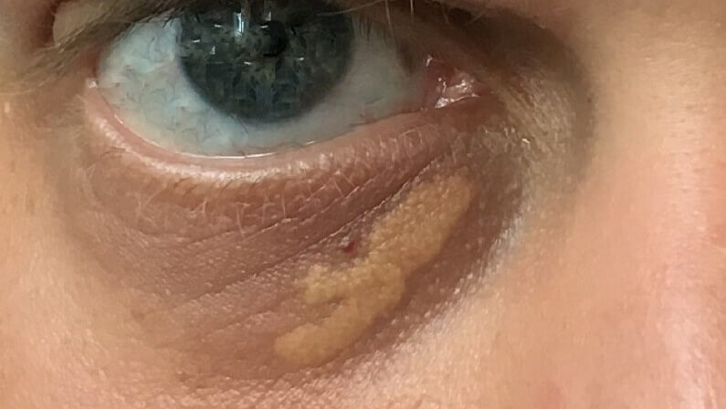 how to get rid of xanthelasma naturally