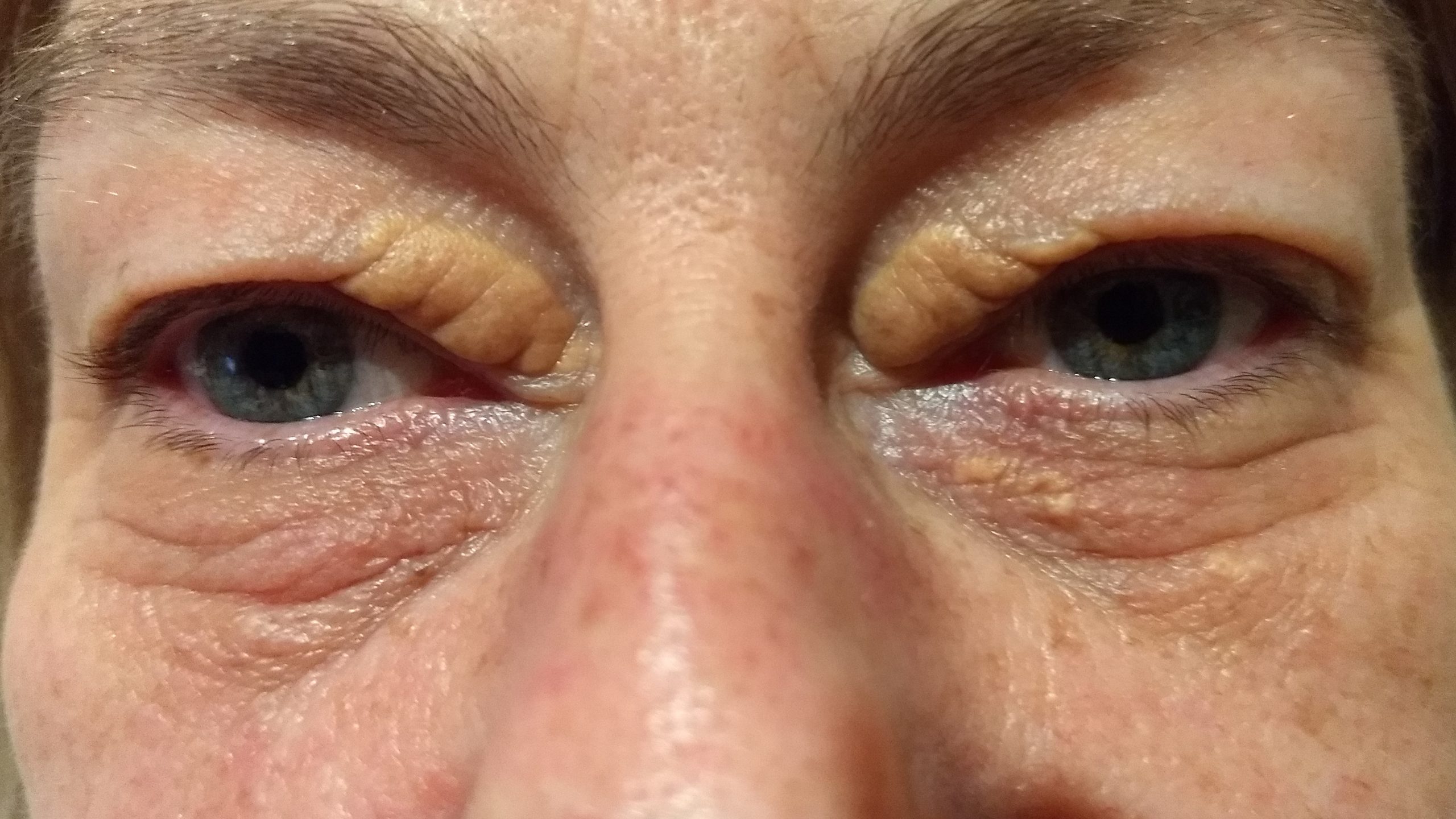 natural techniques to get rid of xanthelasma