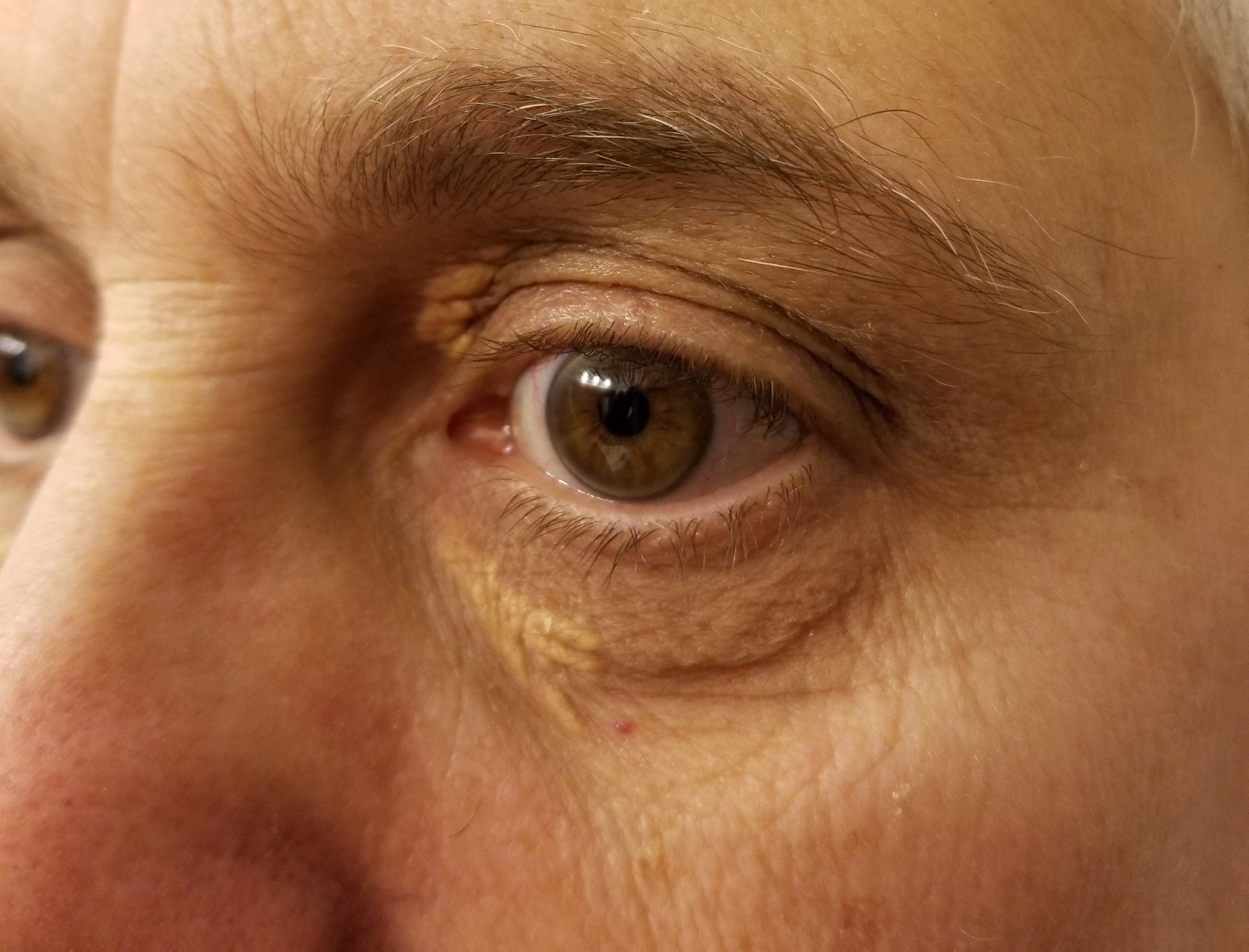 Bilateral eyelid xanthomas on both upper lids